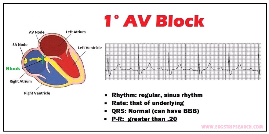 1st Degree AV Block