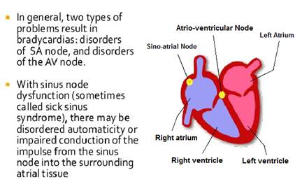 Symptoms Of Sick Sinus Syndrome