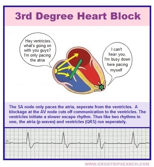 third degree heart block with junctional escape rhythm