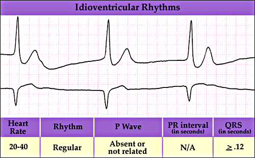 IVR.gif 500×309 pixels | Cardiovascular system, P wave, Nurse